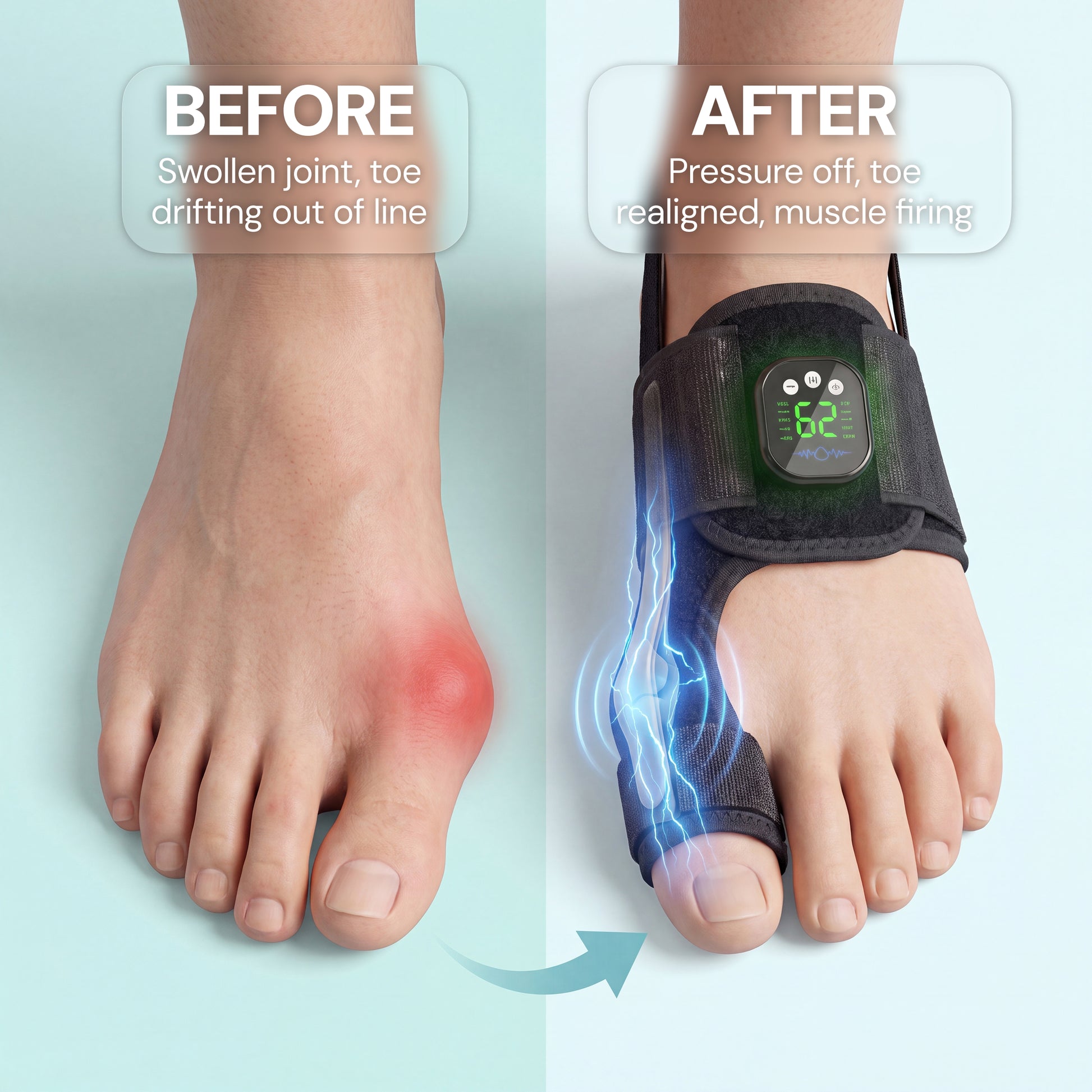 Kadvio's EMS Bunion Corrector